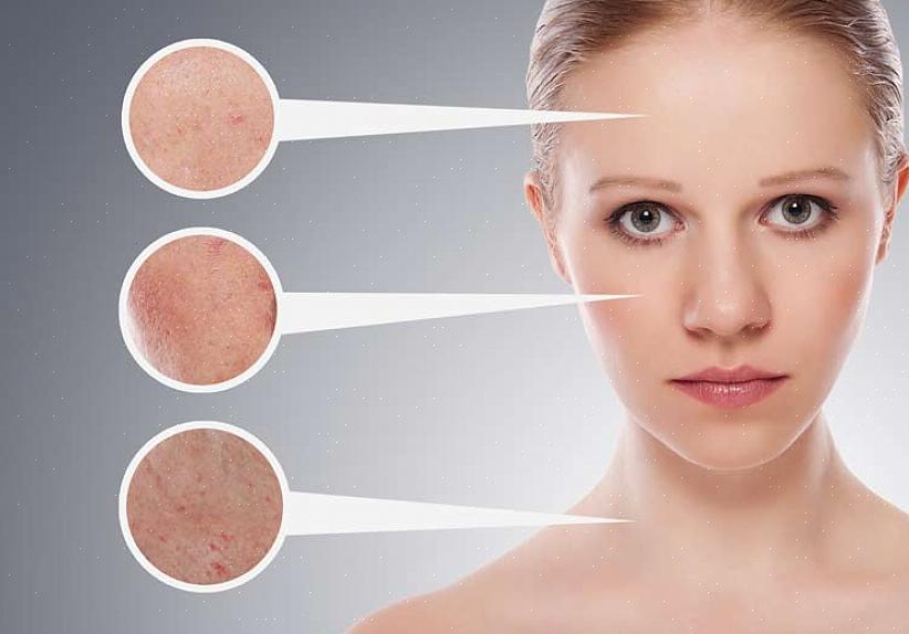 Methylisothiazolinone is een zeer corrosieve chemische stof waarvan is vastgesteld dat deze giftig